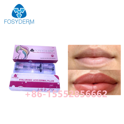 кислота дермального заполнителя 2ml Fosyderm Hyaluronic для повышения губ