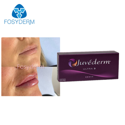 Заполнитель 2x1.0ml повышения губы Juvederm Ultra3 Hyaluronic кисловочный дермальный