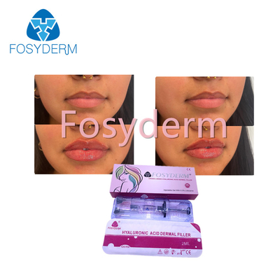 Hyaluronic кисловочный заполнитель Fosyderm впрыски дермальный для креста губы 2ml соединил