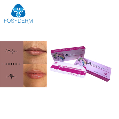 Hyaluronic кисловочный заполнитель Fosyderm впрыски дермальный для креста губы 2ml соединил
