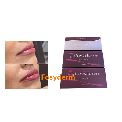 Juvederm 2*1ml Гиалуроновая кислота Dermal Filler Увеличение губ Увеличение подбородка
