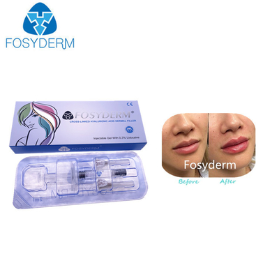 Заполнитель Кореи Hyaluronic кисловочный дермальный для впрыски увеличения губы