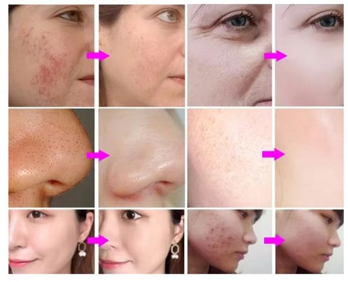 Hydra Peeling Hydra Small Bubble Water Hydro Aqua Facial H2O2 Hydra Machine (Гидра для очистки лица) 2