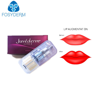 Заполнитель ультра 3 Juvederm Hyaluronic кисловочный дермальный для губ стороны