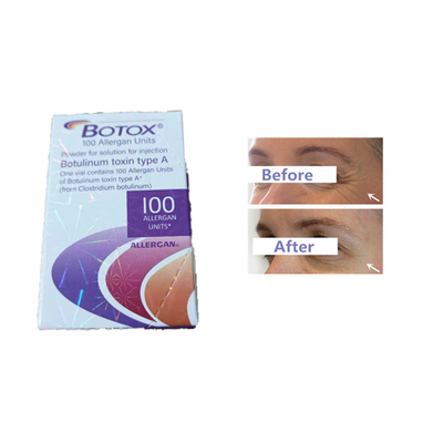 Морщинки лба блоков токсина 100 впрыски Allergan  Botulinum