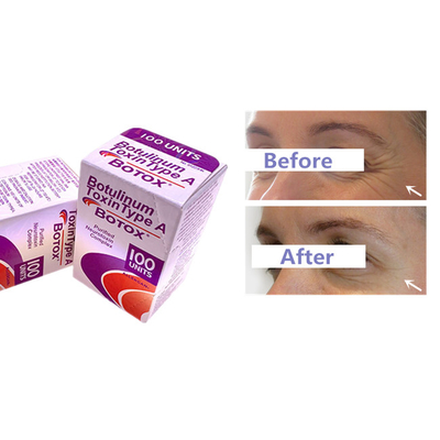 Botulinum впрыска Allergan  токсина для морщинки извлекает