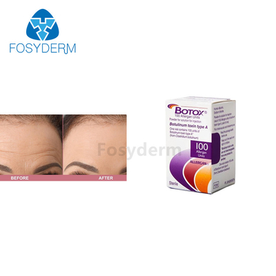 Впрыска токсина Allergan  100 блоков Botulinum для анти- морщинок
