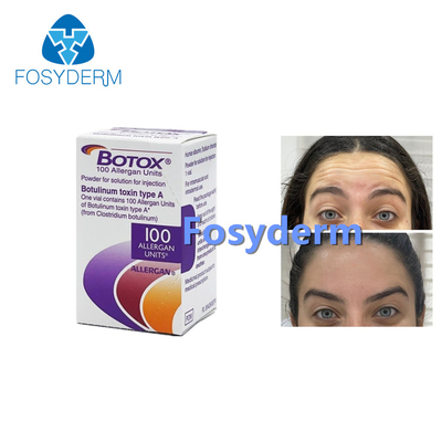 100Units Allergan Botulinum Toxion для извлекают лицевой тип a  морщинок
