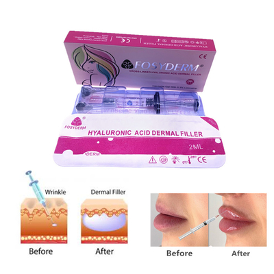 Fosyderm 2ml Гиалуроновая кислота гель Впрыски дерматического наполнителя для ухода за кожей лица и носа