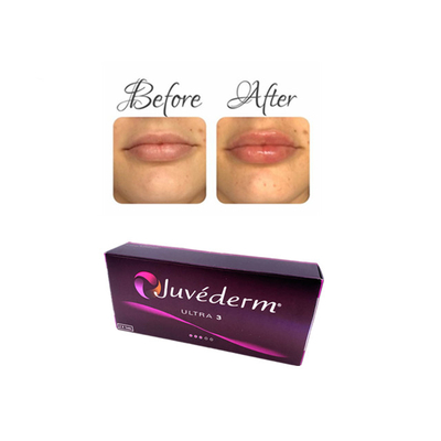 Juvederm Инъекционный гиалуроновый кислотный гель