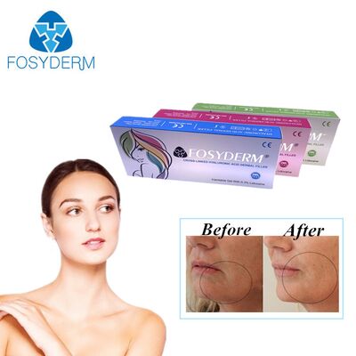Hyaluronic Acid Dermal Filler for Facial Elegance and Lip Enhancement Injection
