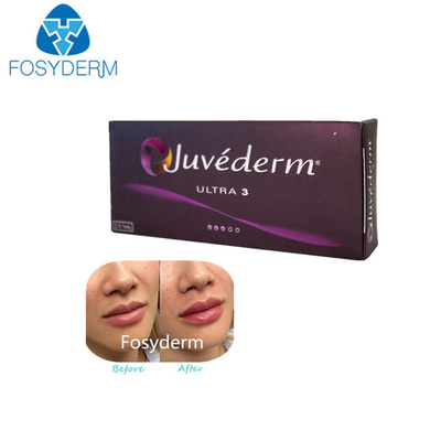Juvederm ультра 3 1 Ml * 2 Hyaluronic кисловочных дермальных впрыски губы заполнителя