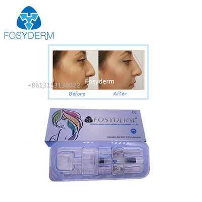 Fosyderm 1 мл гиалуроновой кислоты для увеличения размеров губ
