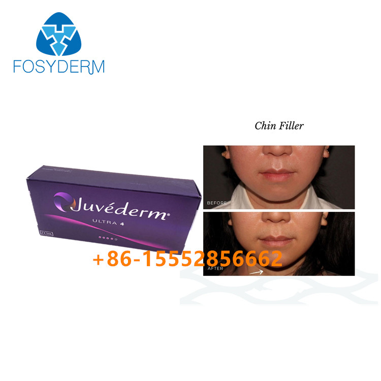 Заполнитель Juvederm Ultra4 дермальное 2ml увеличения Chin Hyaluronic кисловочный лицевой