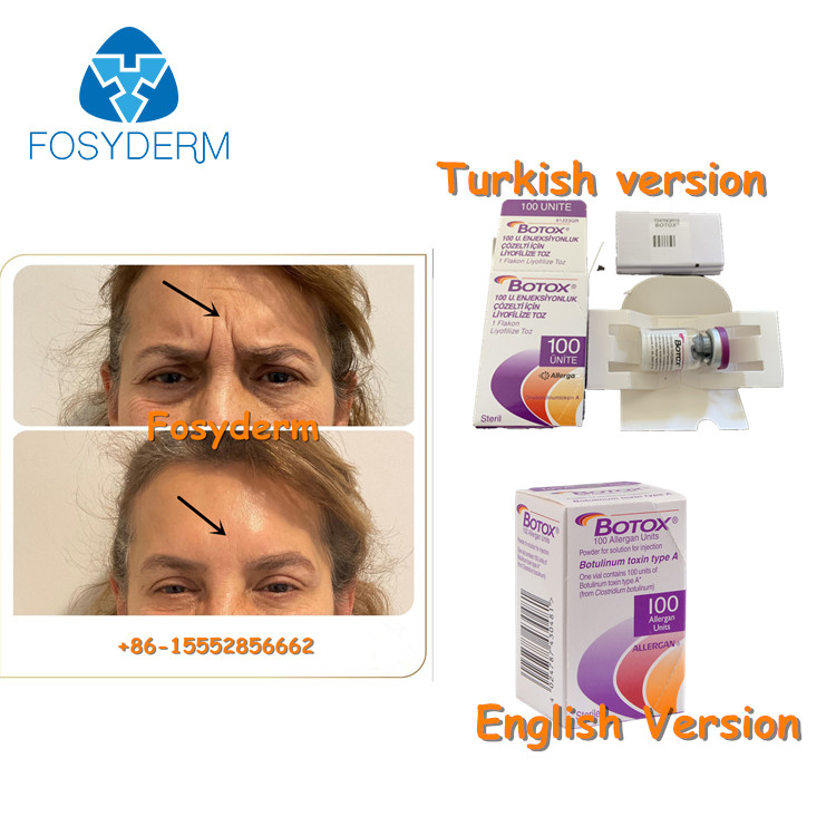 100Units Allergan Botulinum Toxion для извлекают лицевой тип a  морщинок
