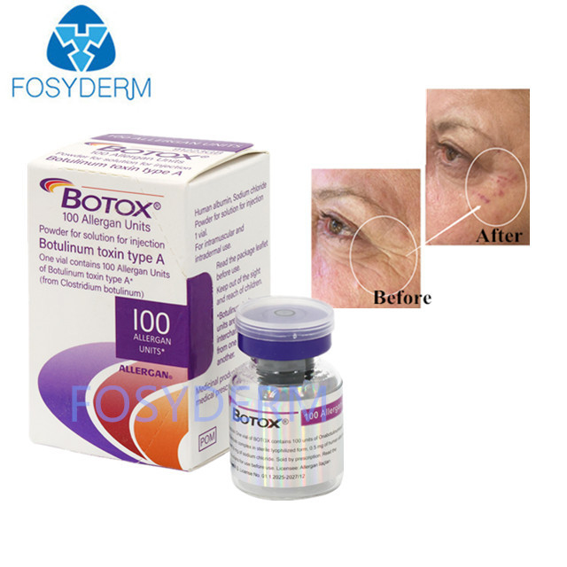 Тип А 100 единиц Аллерген ботулинический токсин Dermal Filler Гиалуроновая кислота