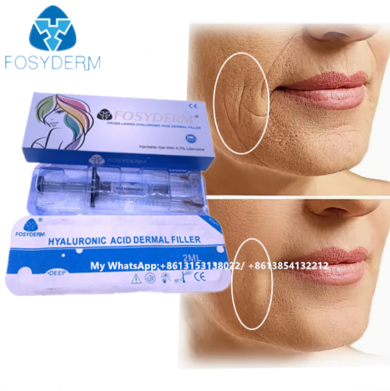Long-Lasting Cross-Linked Hyaluronic Acid Dermal Filler Gel Injectable Fosyderm