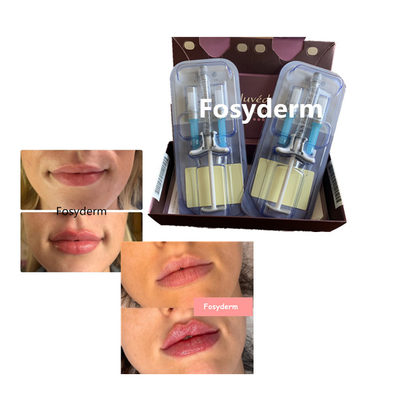 Крест заполнителя губ volbella Juvederm Hyaluronic кисловочный соединил 24mg