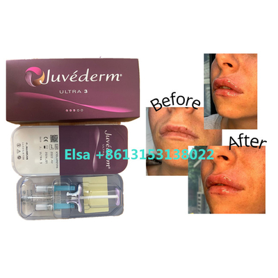 Заполнитель Juvederm косметических продуктов дермальный для губ стороны