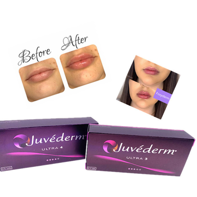 Hyaluronic кисловочный дермальный Ce анти- старея 2ml заполнителя губы Juvederm впрыски геля