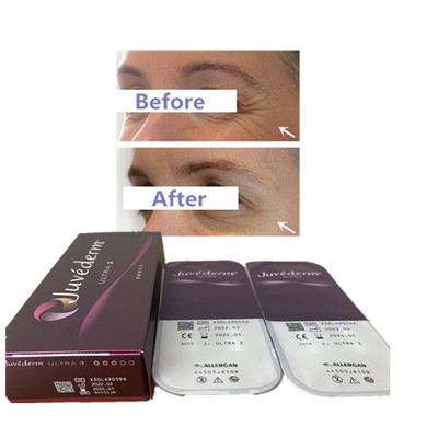 Заполнитель 24mg губы заполнителя Juvederm 2ml Ultra3 Ultra4 Voluma Hyaluronic кисловочный дермальный