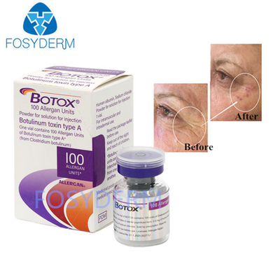 Тип А 100 единиц Аллерген ботулинический токсин Dermal Filler Гиалуроновая кислота