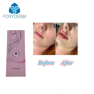 впрыска заполнителя губы Lidocaine 1ml 0,3% Hyaluronic кисловочная