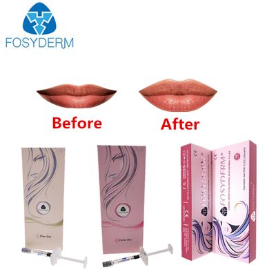 Заполнитель морщинок и губ Hyaluronic кисловочный вводимый с Lidocaine