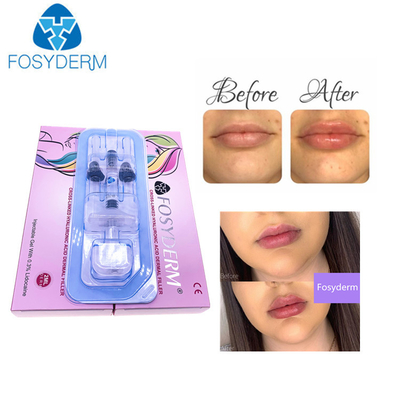 Заполнитель аттестации 1ml глубокий Hyaluronic кисловочный Derm HA CE дермальный для губ
