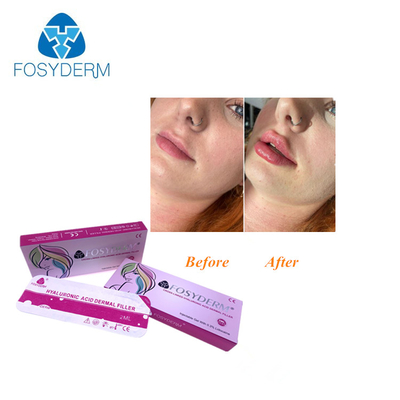 Hyaluronic кисловочный дермальный вводимый заполнитель для стороны носа